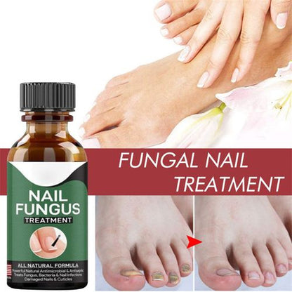 Nail Fungus Solution In Pakistan By Pure Care
