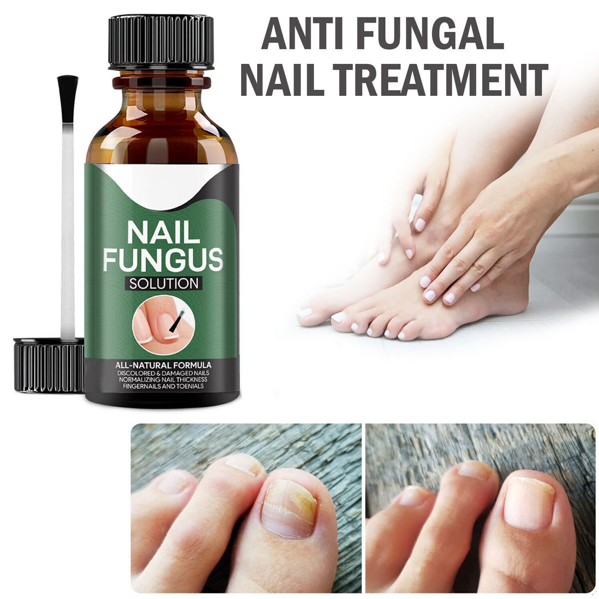 Nail Fungus Solution In Pakistan By Pure Care